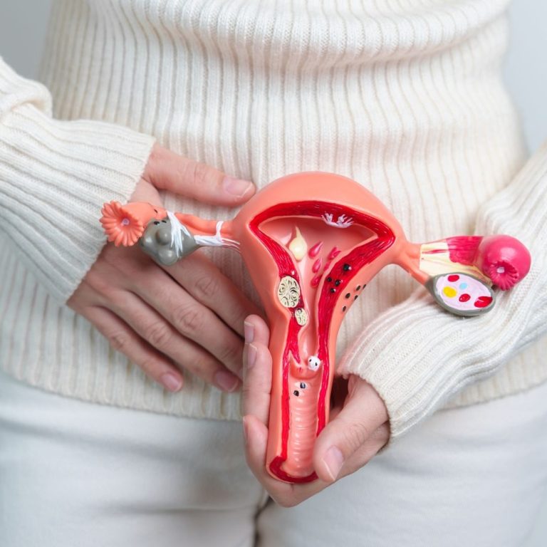 Does a Hysterectomy Cure PCOS? PCOS Weightloss