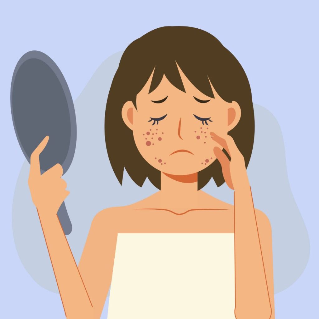 pcos and dark skin patches