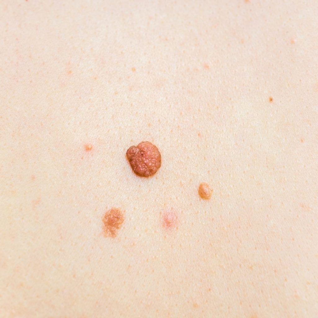 pcos and skin tags