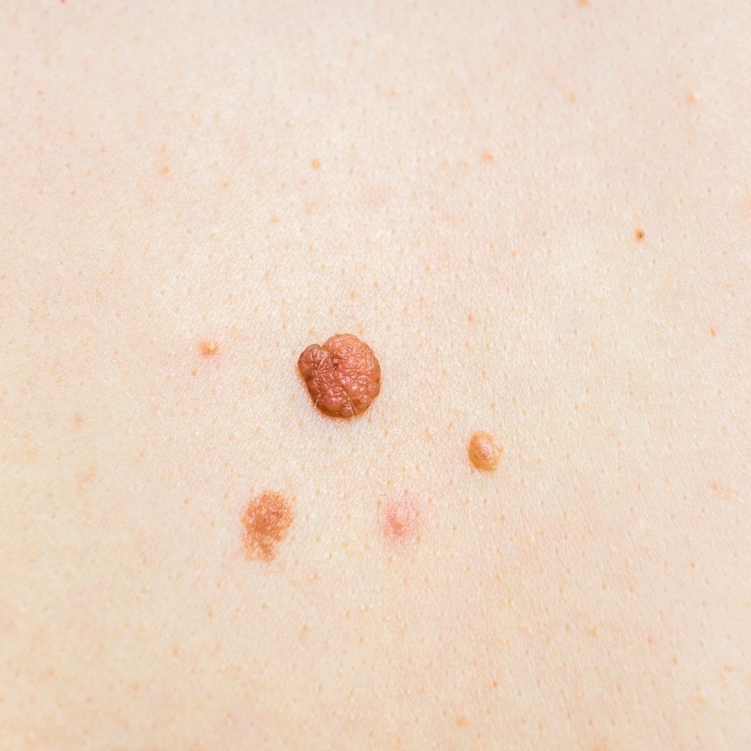 pcos and skin tags