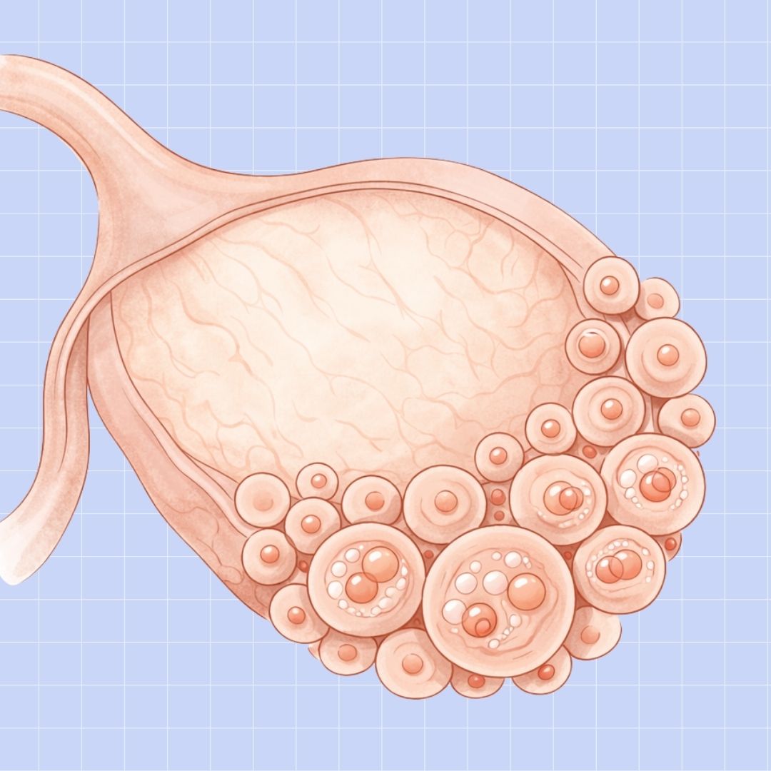 PCOS Ovulation Pain: Why It Happens and How to Fix It