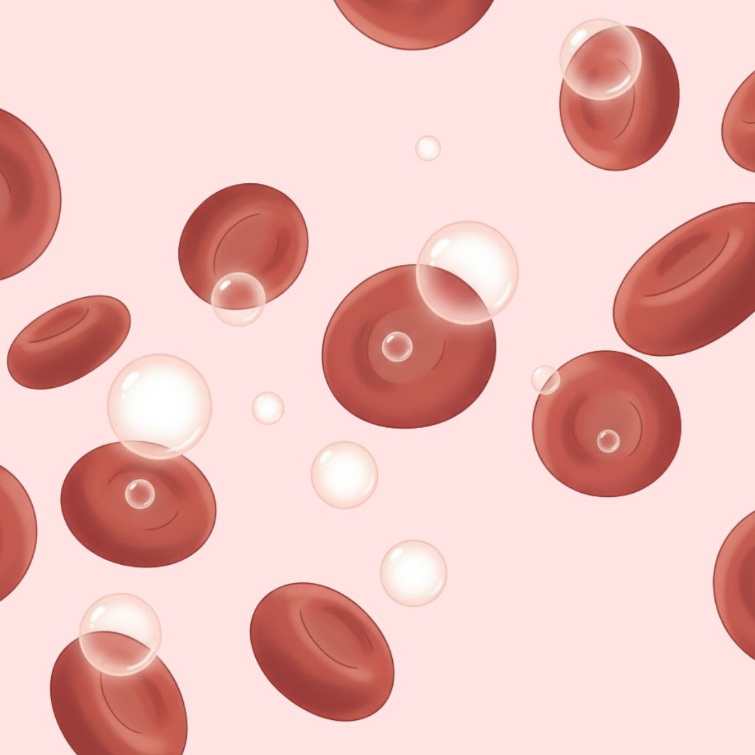 PCOS High Levels of Iron: Symptoms, Causes, and Support